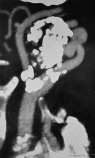 Angioscanner : volumineux anévrisme carotidien partiellement calcifié et thrombosé mais toujours circulant.