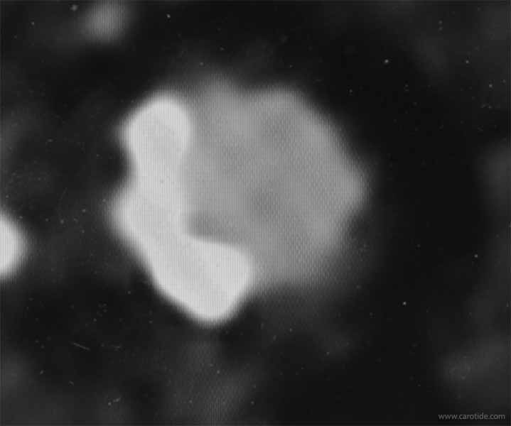 Angioscanner : coupe native du bulbe carotidien qui est le siège d’une plaque athéromateuse calcifiée peu sténosante (20% en critères ECST).
