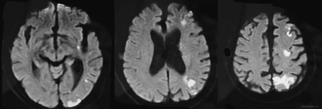 IRM cérébrale : multiples infarctus sur les clichés en diffusion.