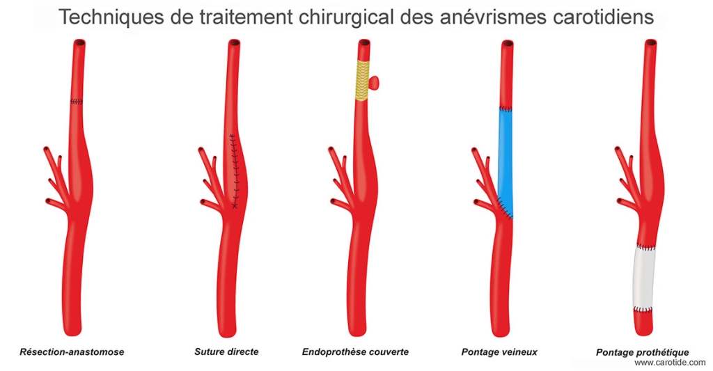 Techniques de traitement chirurgical des anévrismes carotidiens
