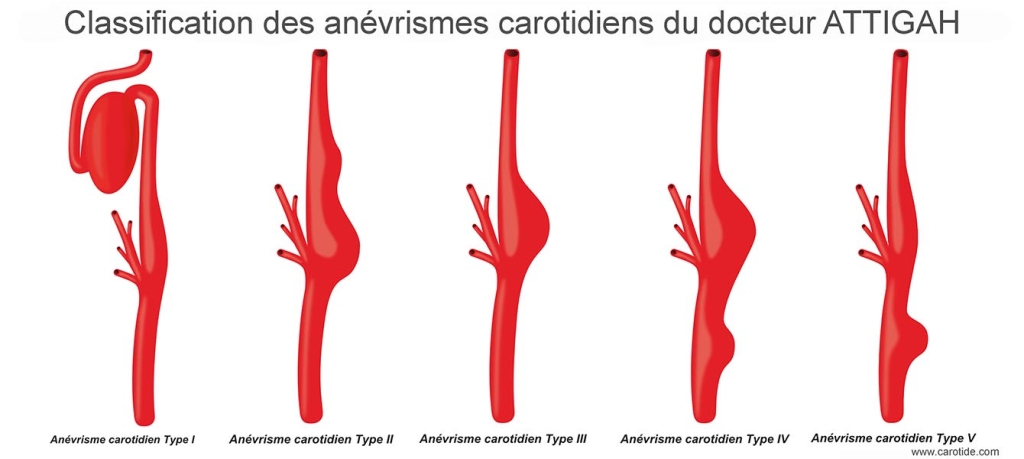anévrismes carotidiens classification du docteur Attigah
